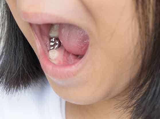 Up-close view of a dental crown inside a child’s mouth